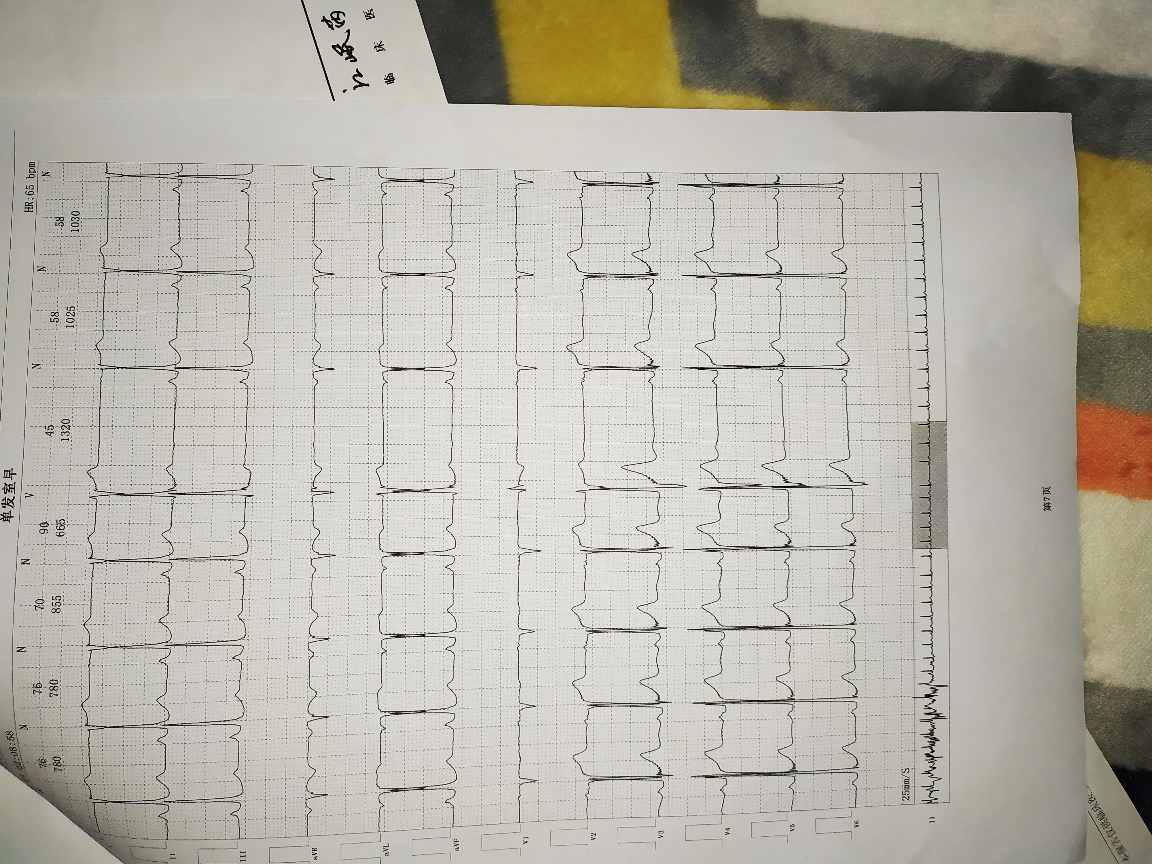 心电图v1-v3呈qs型图片
