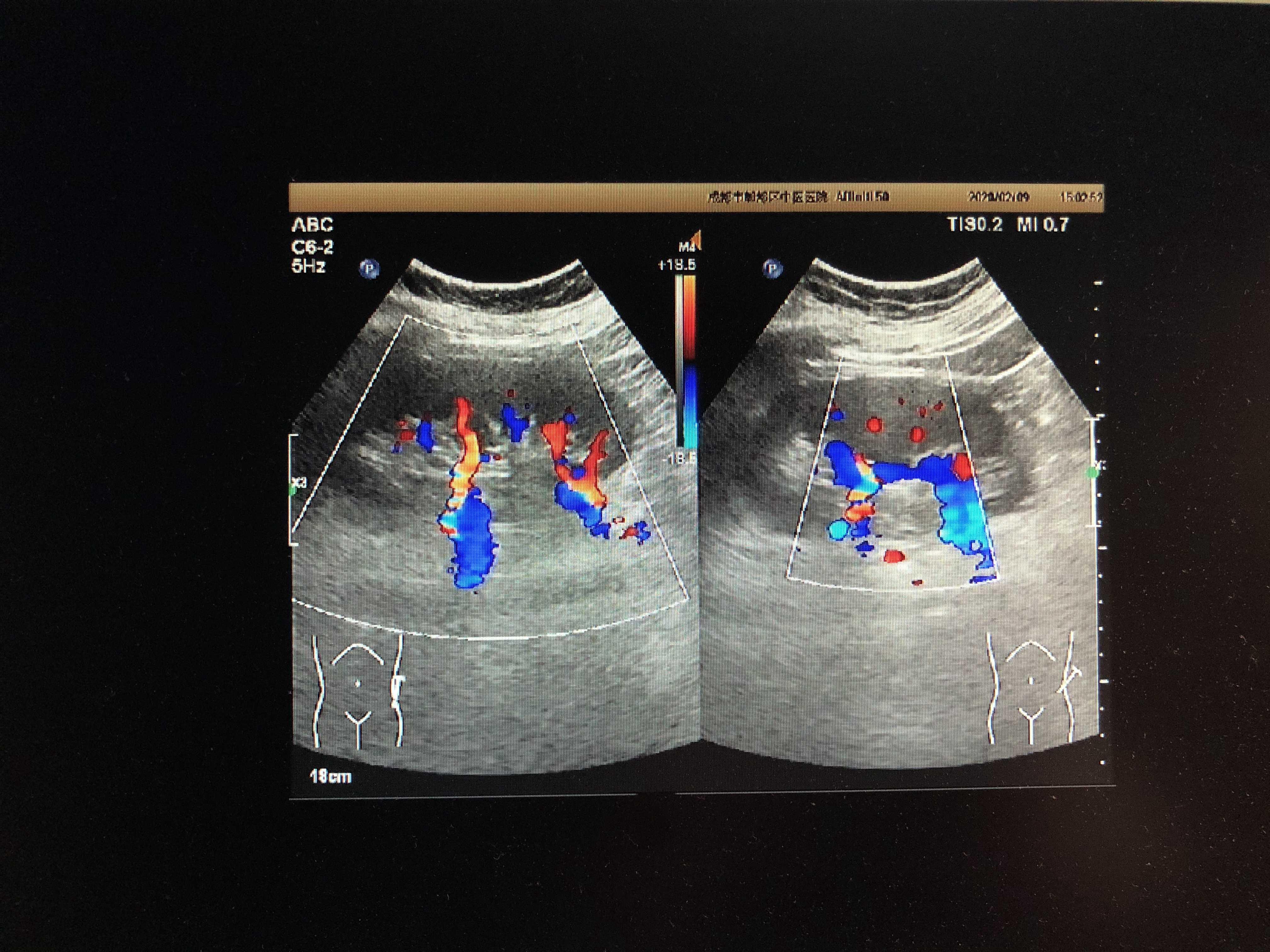 左肾副肾动脉 - 超声医学讨论版 - 爱爱医医学论坛