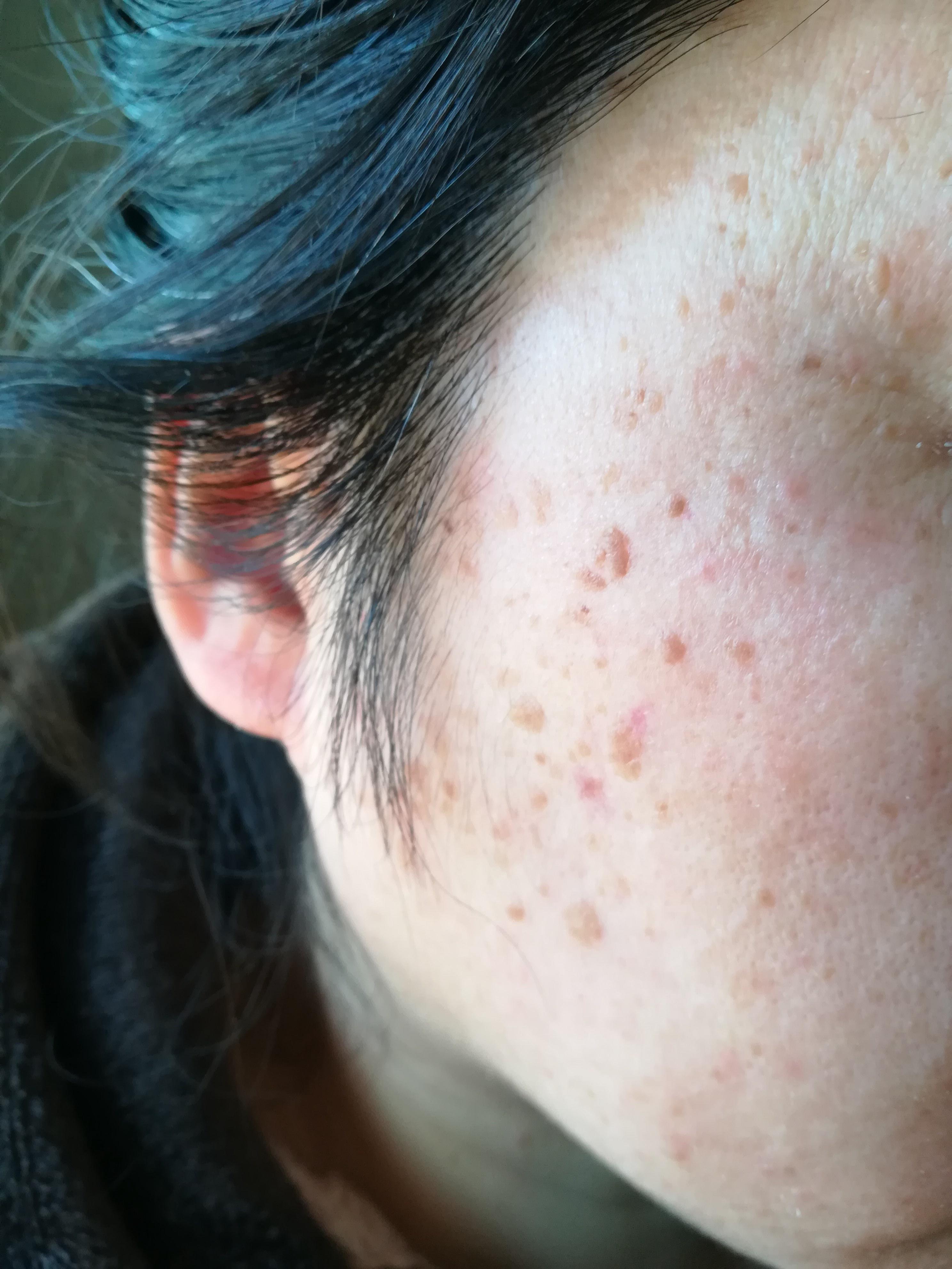 这脸上是什么原因引起的皮肤病