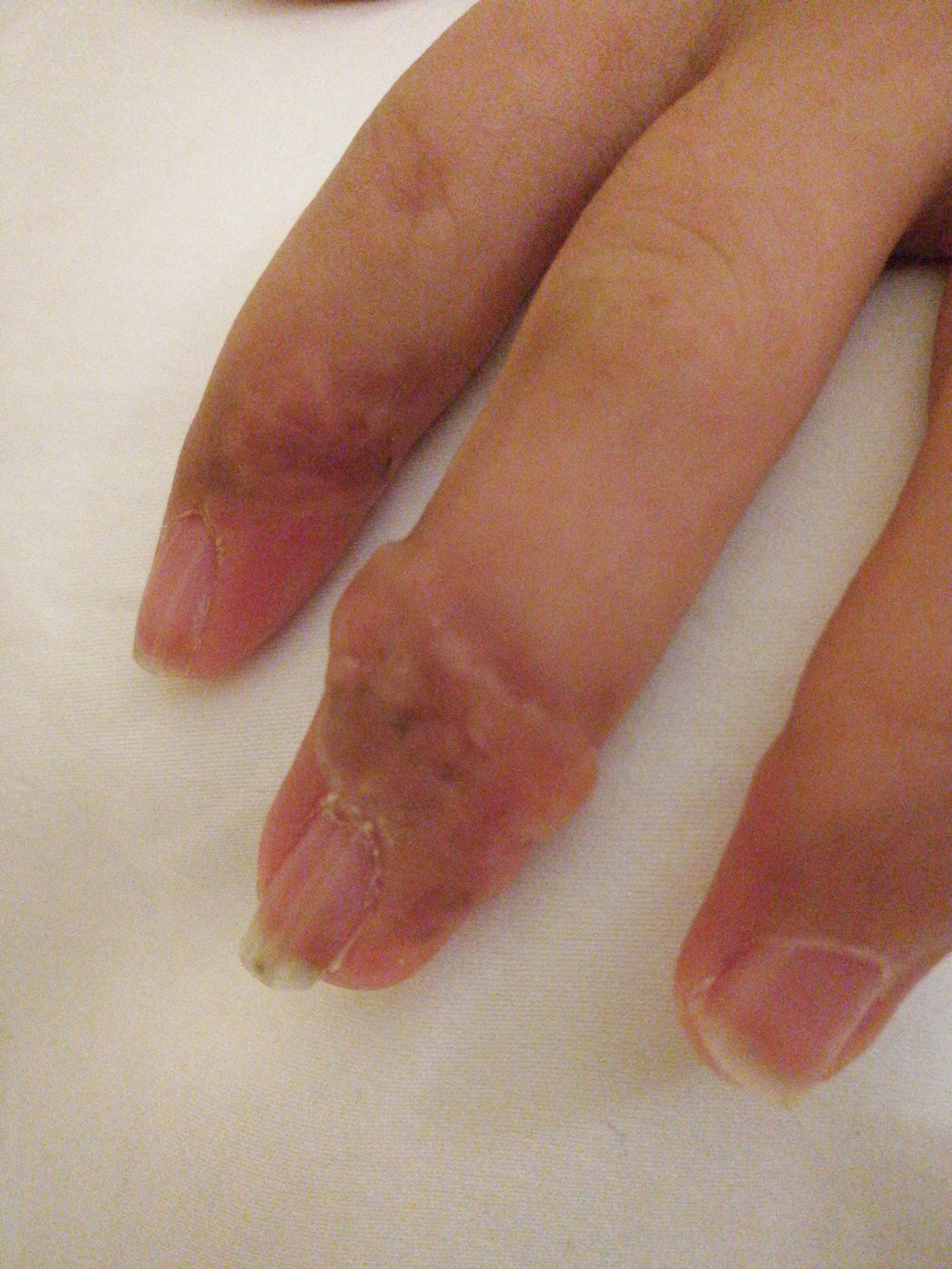 皮肤版u盘奖励典型病例011婴儿指趾纤维瘤病