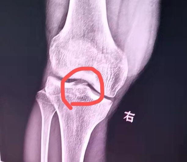 膝关节x片的协诊 是否有胫骨平台骨折 骨科与显微外科专业讨论版 爱爱医医学论坛