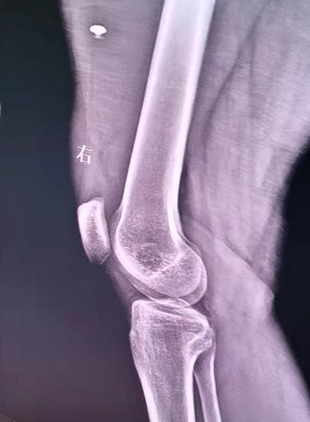 膝关节x片的协诊 是否有胫骨平台骨折 骨科与显微外科专业讨论版 爱爱医医学论坛