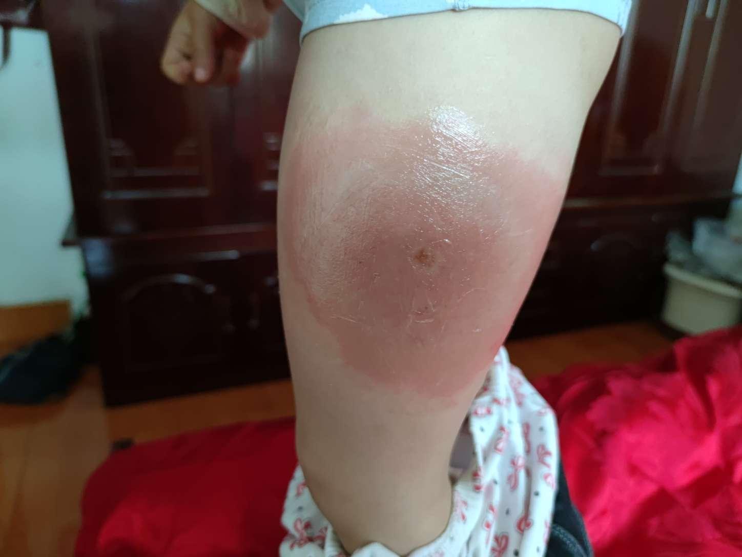 膝盖荨麻疹图片