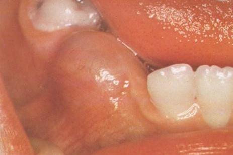 儿童口腔囊肿初期图片图片