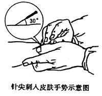 腕管封闭进针部位图片