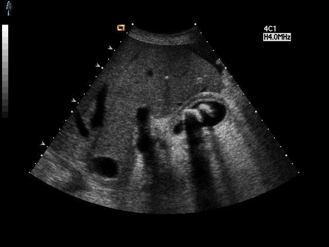 胆囊炎 胆囊结石.jpg