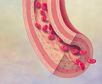动脉粥样硬化的美图