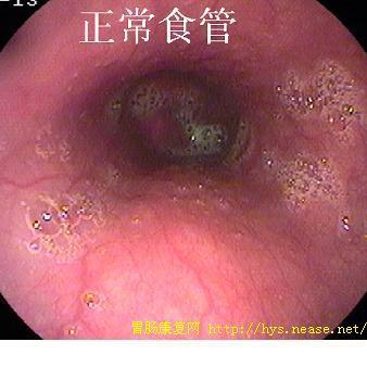 胃的血管和胃镜图片