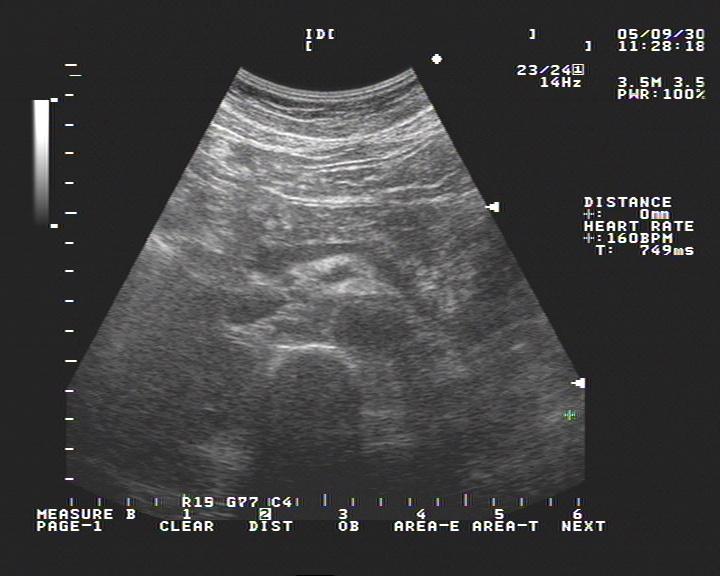 环状胰腺超声图像图片