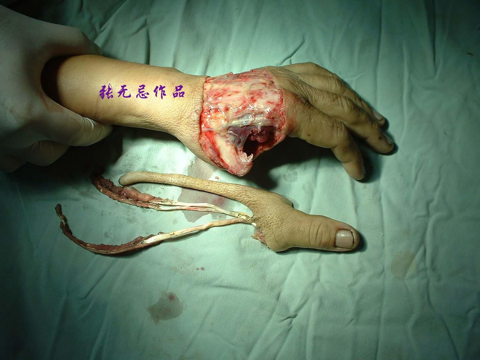 原创左拇指旋转撕脱离断伤再植术