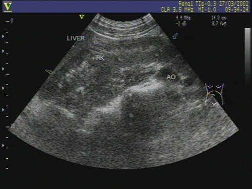 【讨论】给大家几幅超声图片看看 - 超声医学讨论版 - 爱爱医医学论坛