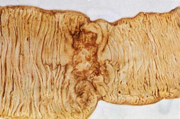 肠结核病理图片图片
