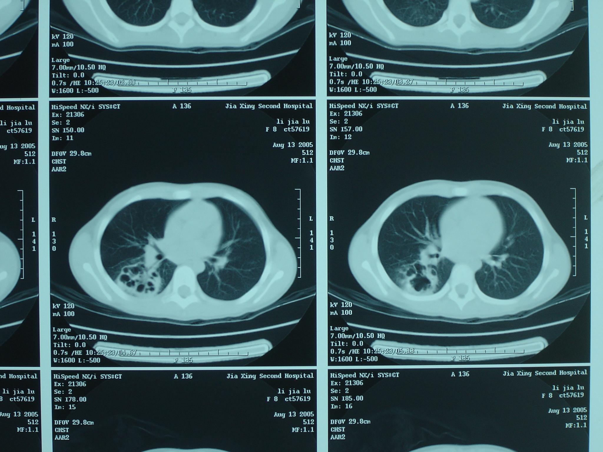 【讨论】肺脓疡?