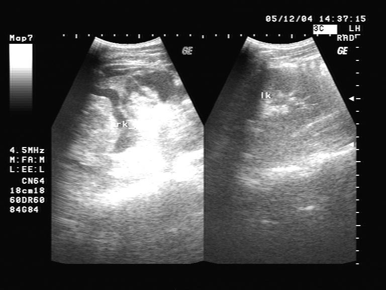 【贴图】肾挫伤b超图片 - 超声医学讨论版 - 爱爱医医学论坛