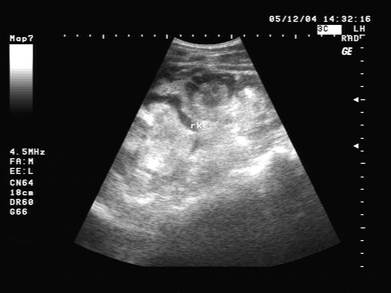 【贴图】肾挫伤b超图片 - 超声医学讨论版 - 爱爱医医学论坛