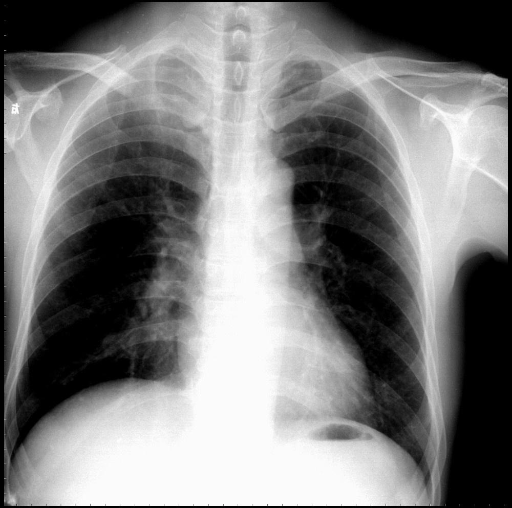 【贴图】少见x光片资料共享(第13次更新2006-1-13) - 医学影像学资源