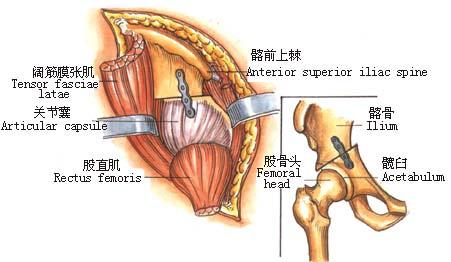 先天性髖關節脫位的手術