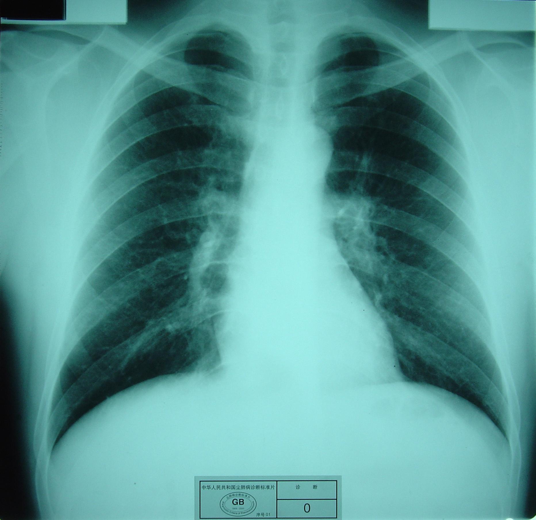 二期尘肺图 40万图片