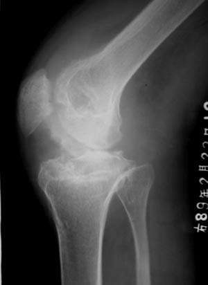 贴图膝关节结核