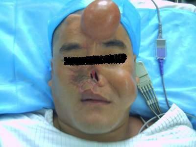 鼻子假体失败案例图片