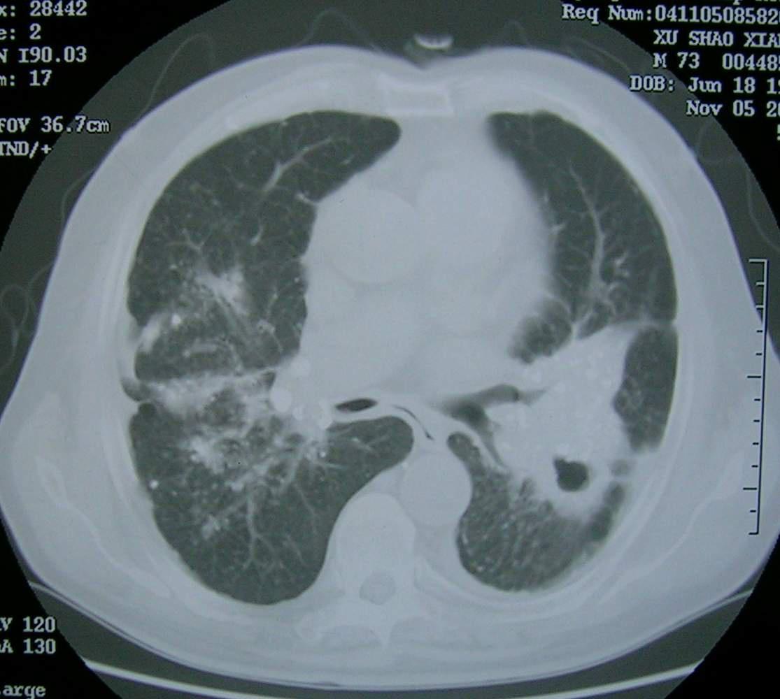 矽肺三期图片