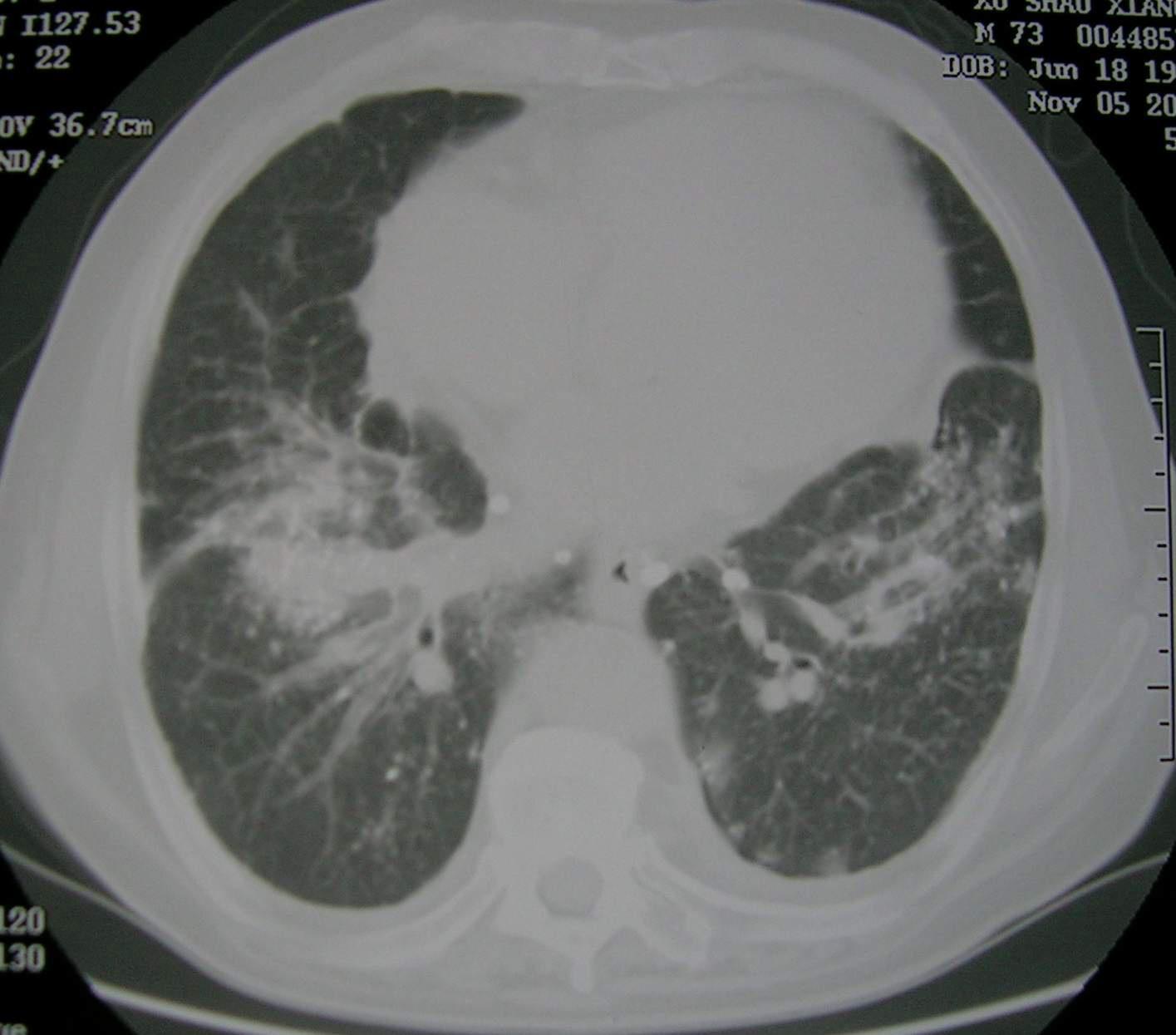 硅肺x线图片图片