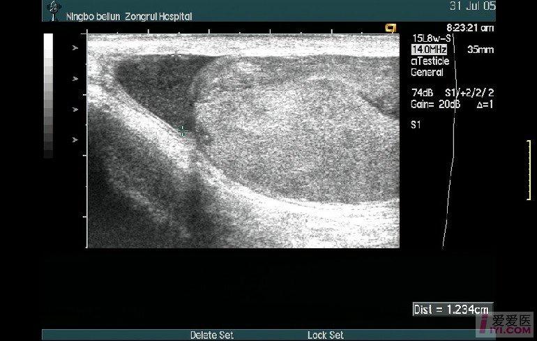 睾丸鞘膜腔内见最大深度约12mm液性暗区