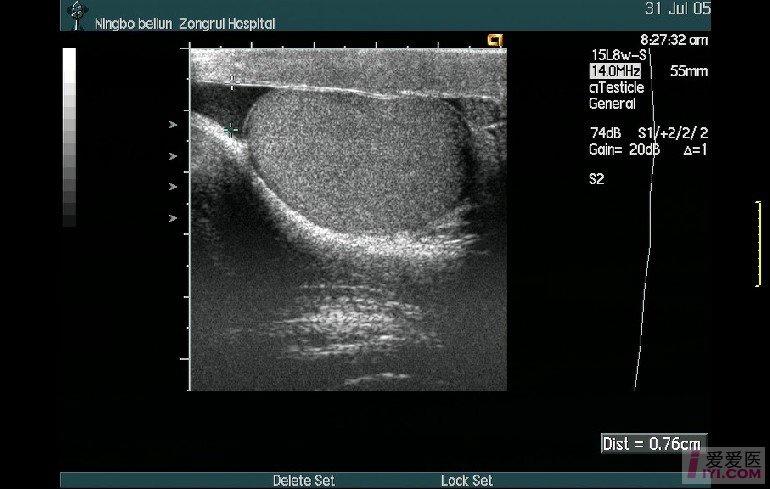 睾丸炎性结节图片