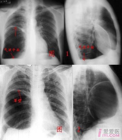 癌性空洞图片