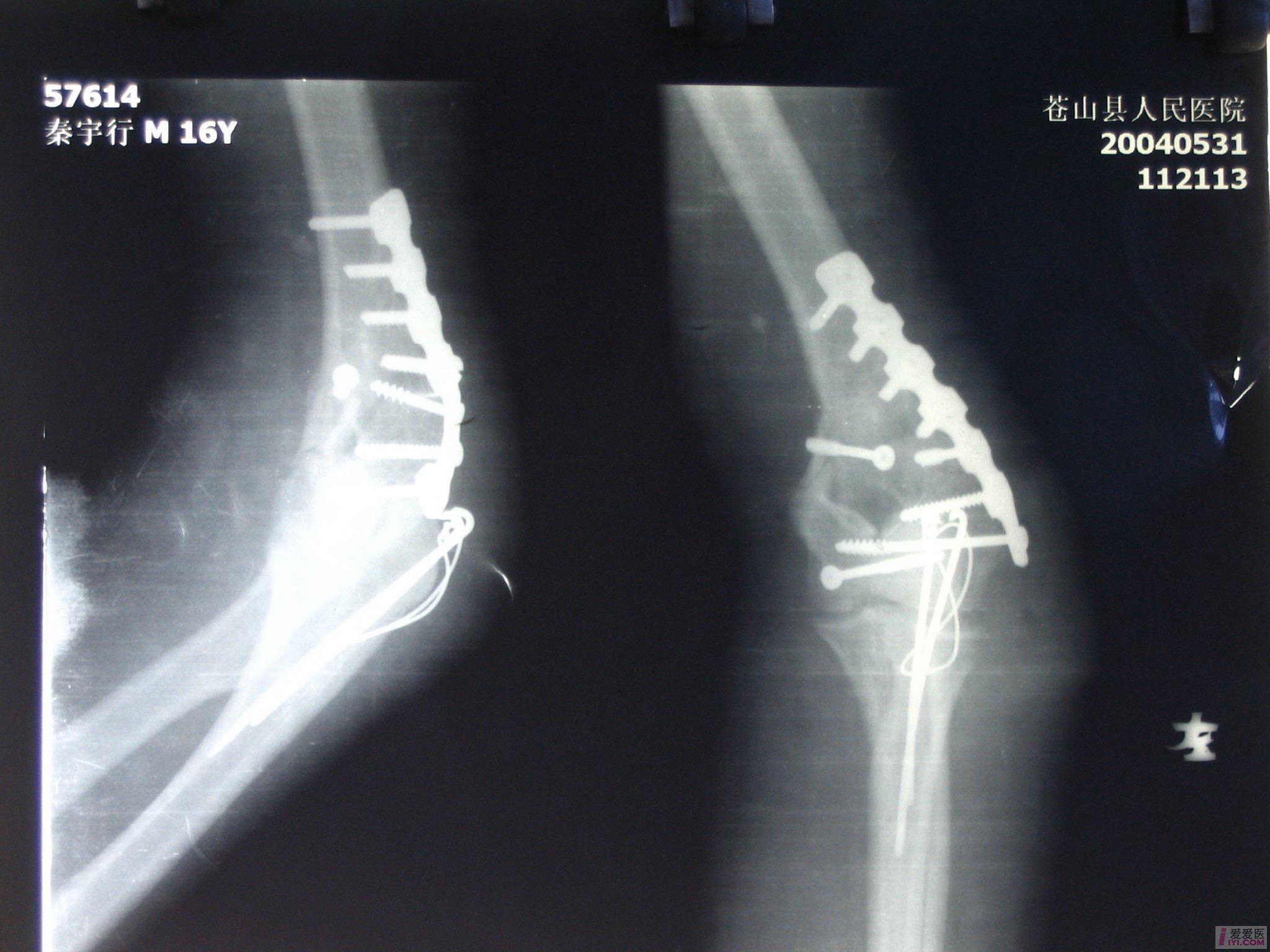 肱骨髁間粉碎性骨折內固定術前術後