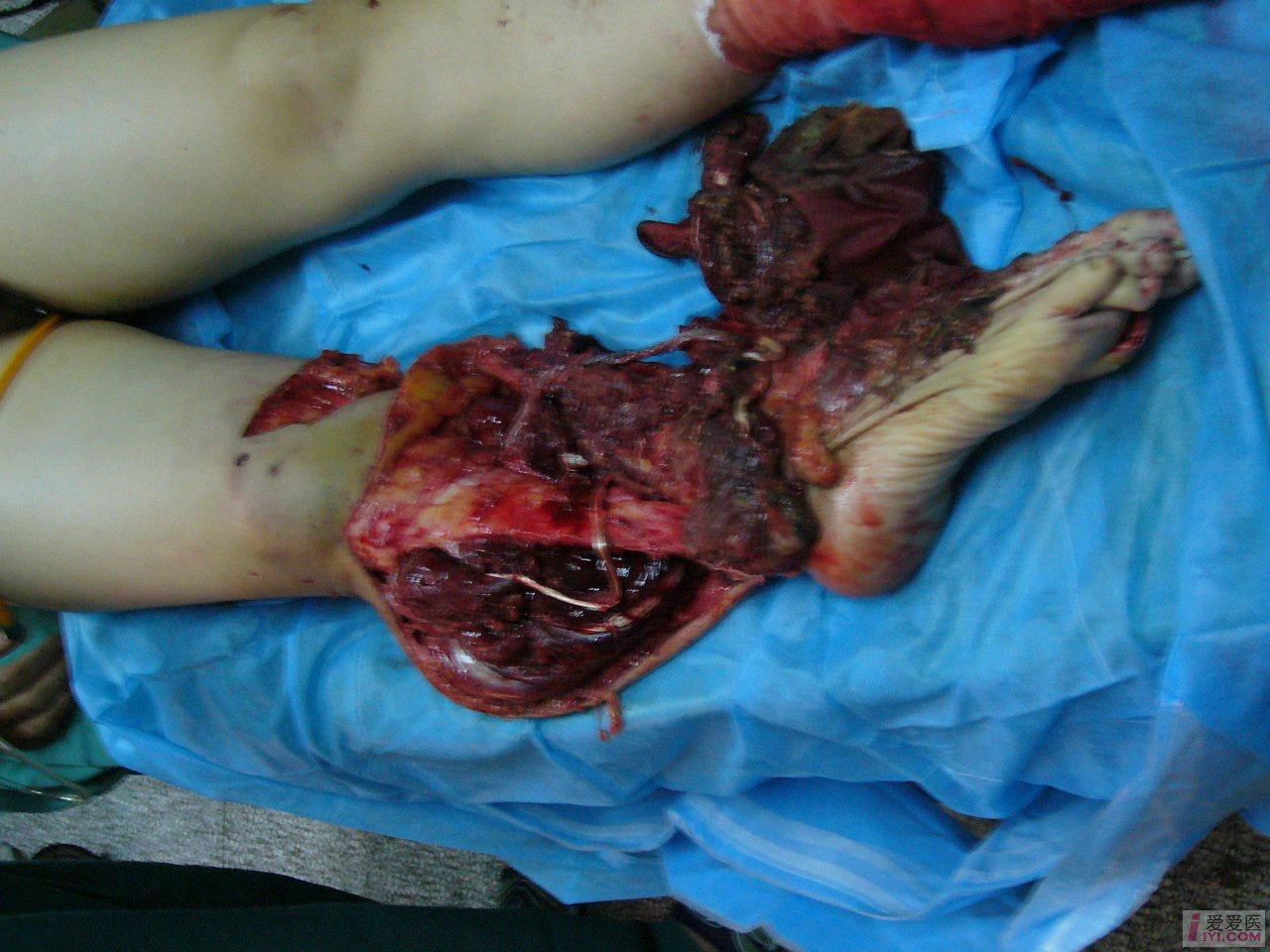 原创双小腿双足毁损伤