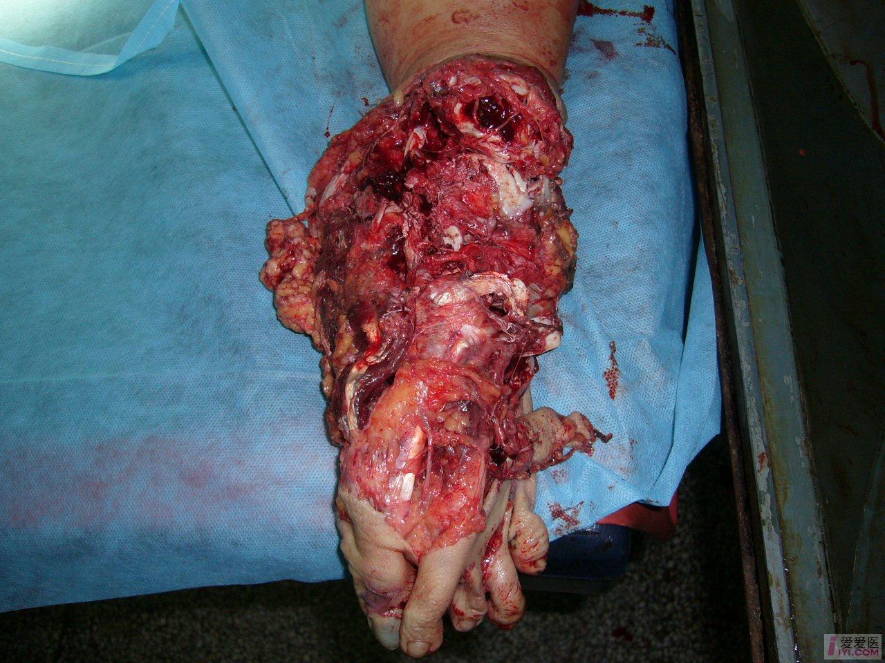 原创双小腿双足毁损伤