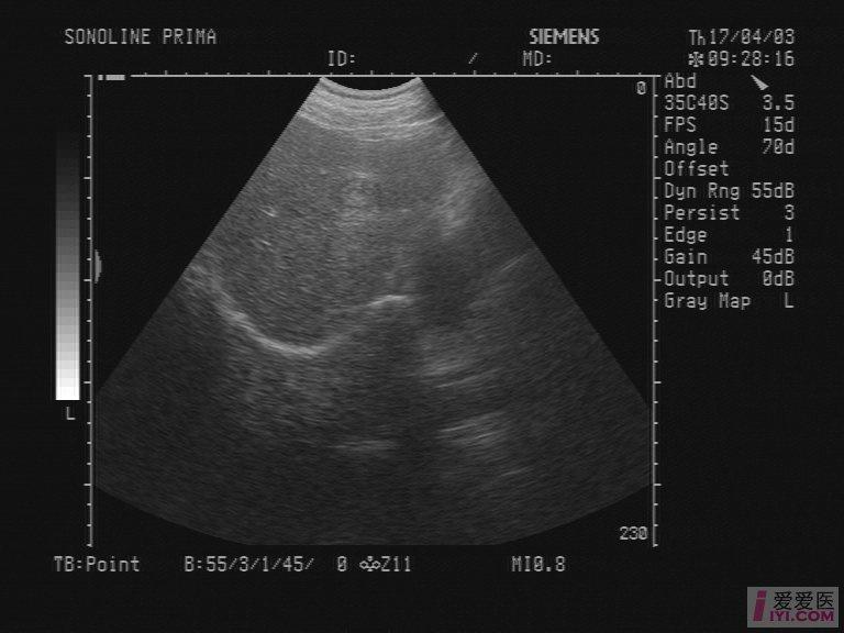 肝右叶探及大小25*21mm等回声光团,周边有声晕,呈牛眼征&quot