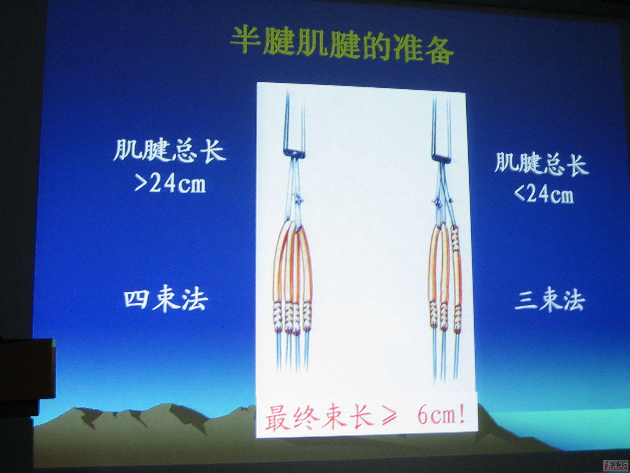 【贴图】半腱肌 缝线钢板重建前交叉韧带