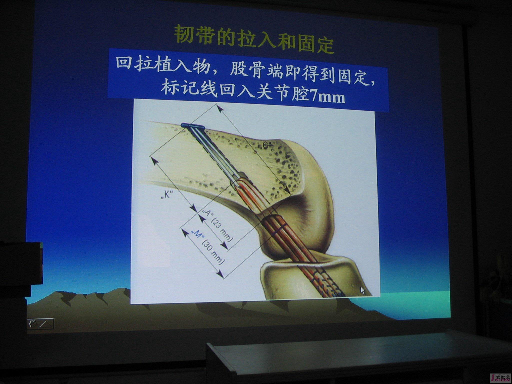 【贴图】半腱肌 缝线钢板重建前交叉韧带