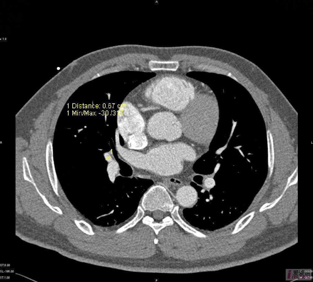 肺动脉ct图像图片