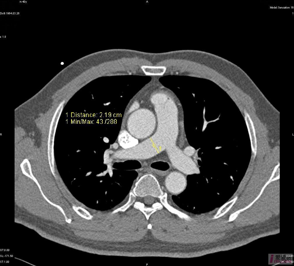 正常肺ct表现图片图片