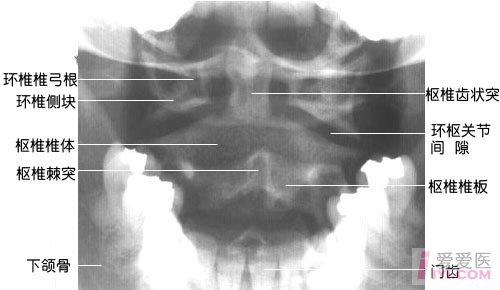 【贴图】几张非常清晰实用的骨科x线图片
