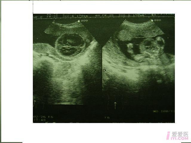 本人收藏:胎儿四肢短小畸形