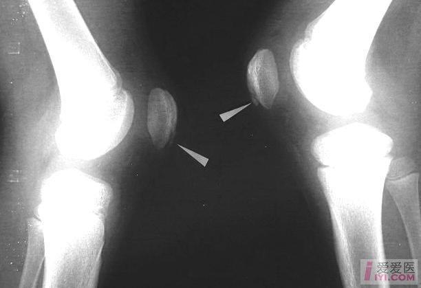 髌骨骨骺线图片