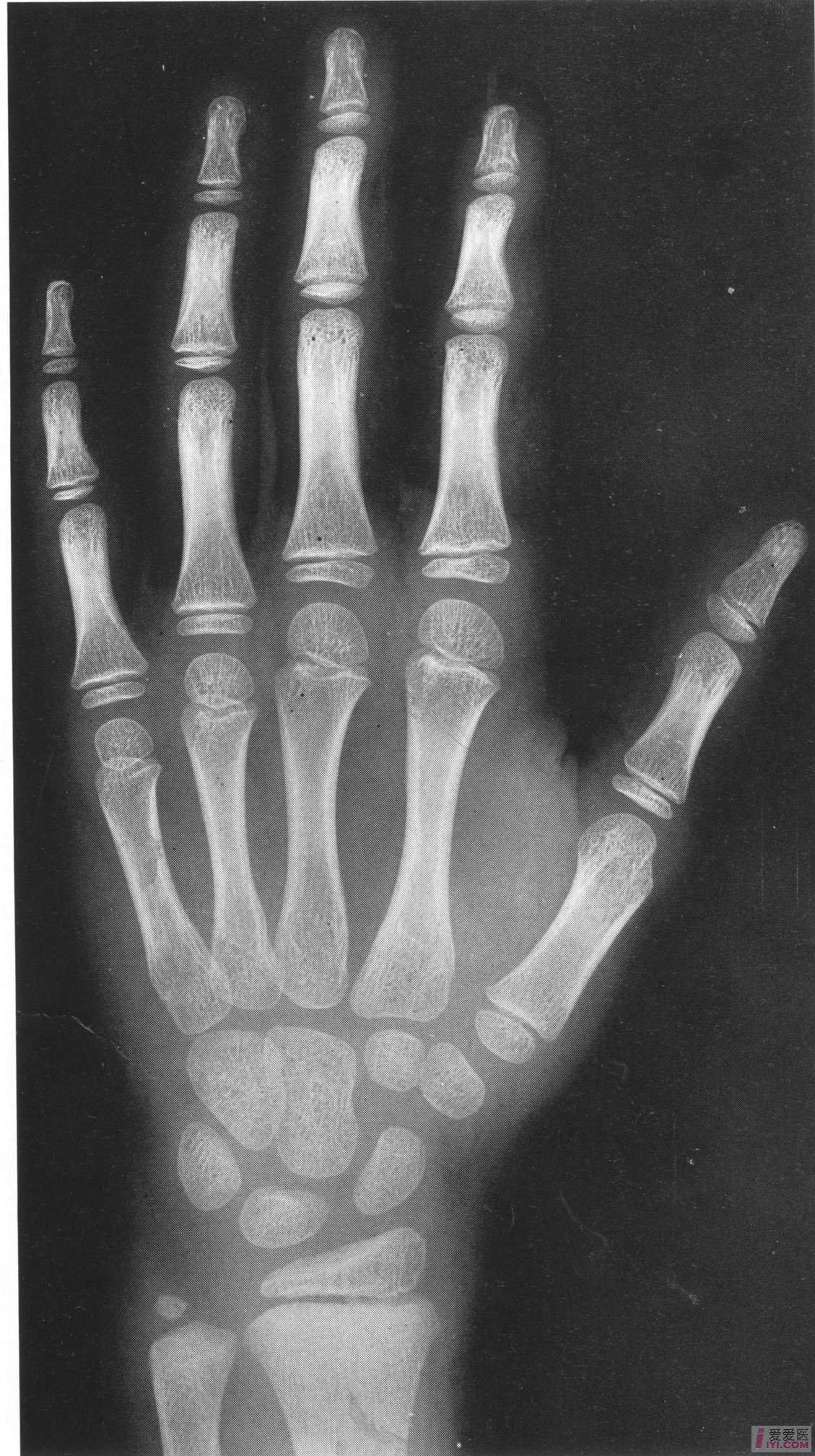 女性标准骨龄图谱   6岁.jpg