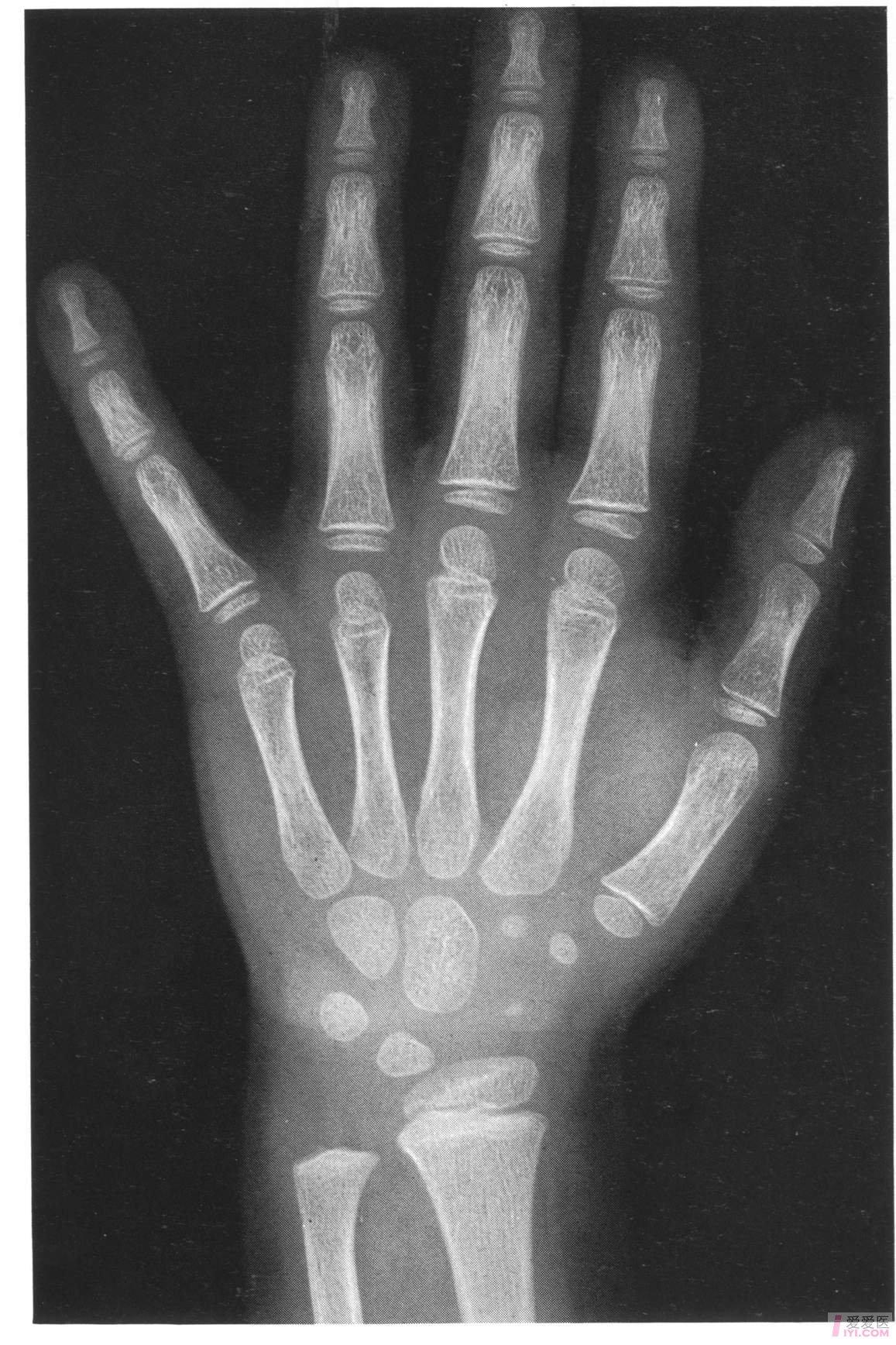 中国儿童标准骨龄片