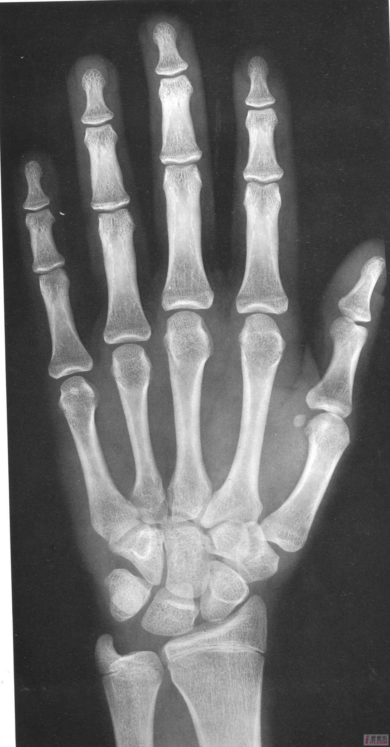 中国儿童标准骨龄片