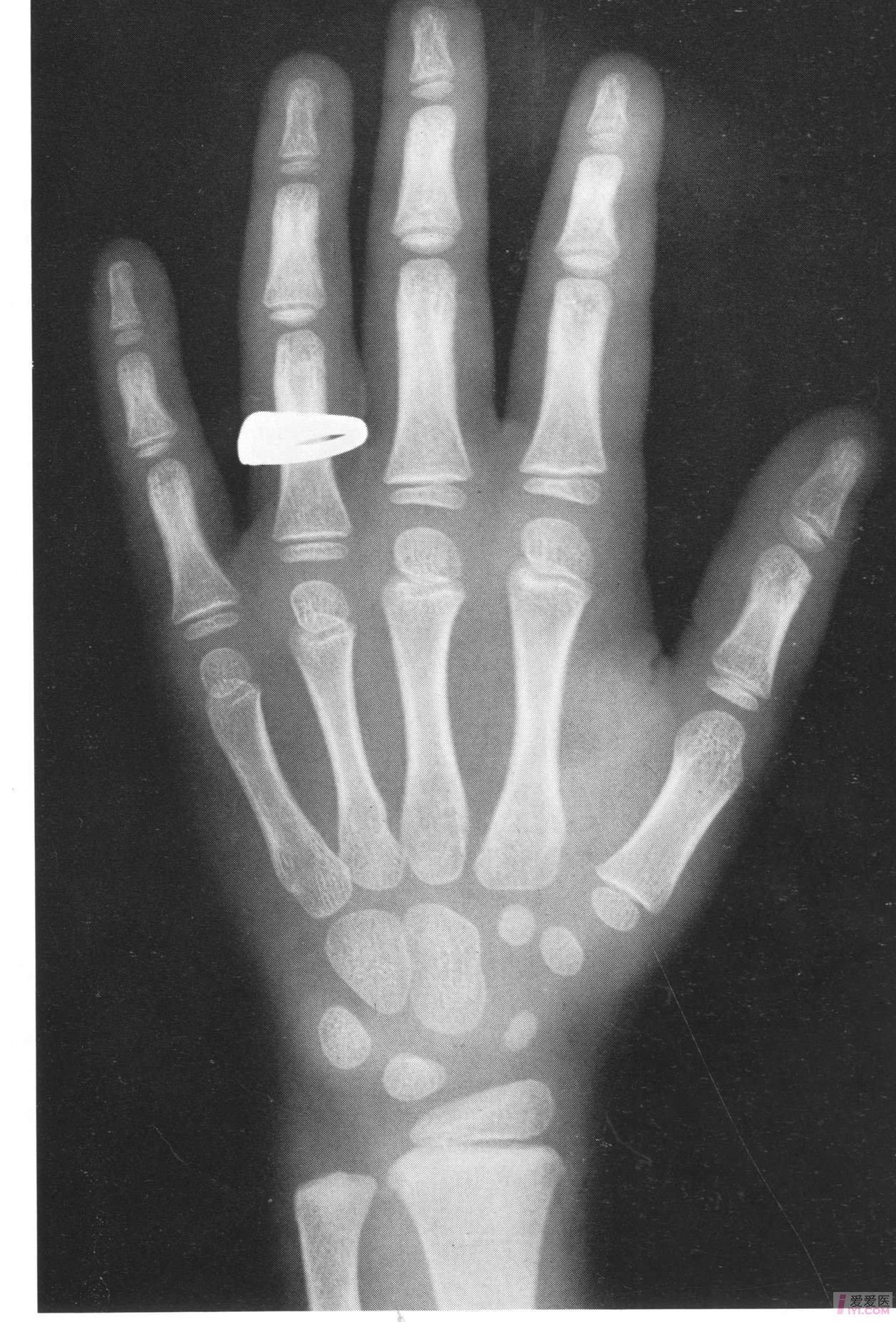 中国儿童标准骨龄片