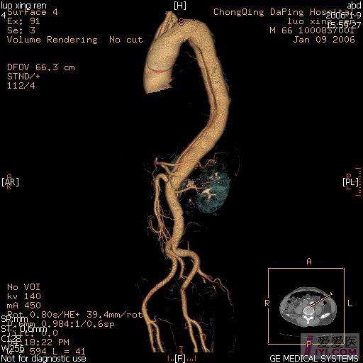 分享主动脉夹层cta