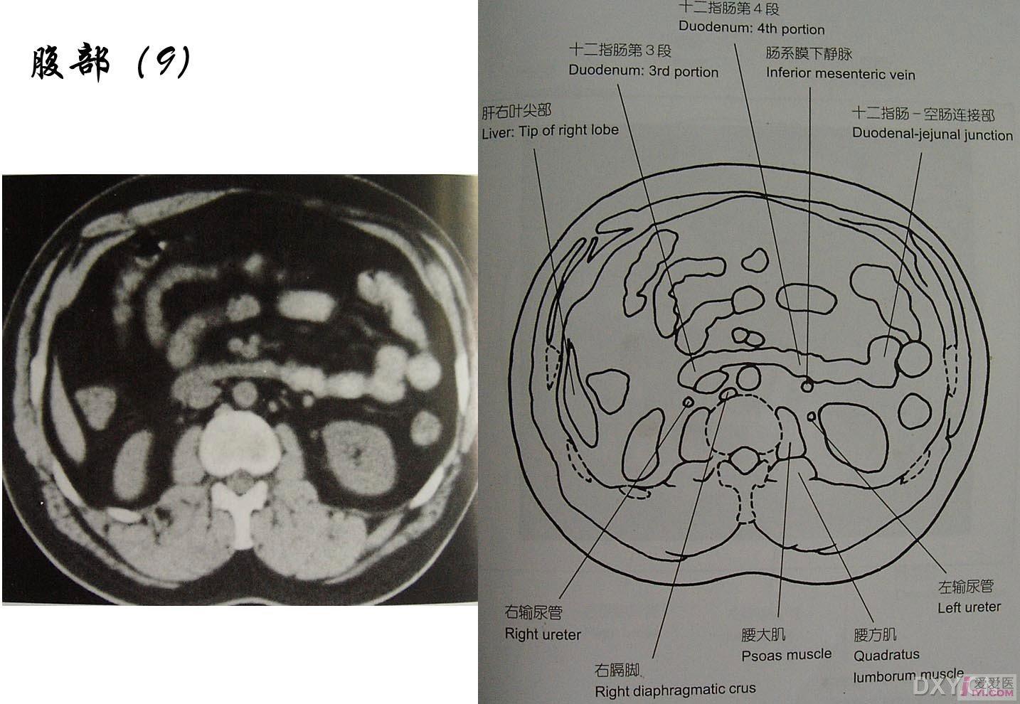 贴图正常腹部ct图像和解剖学对照很好的ct入门图片