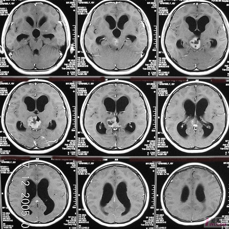 脑瘤片子图片