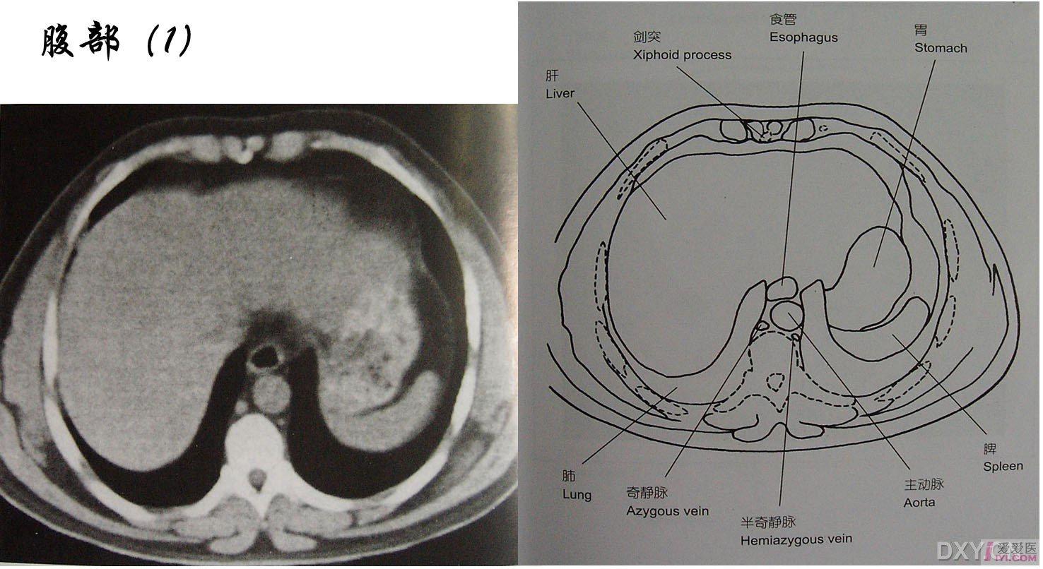 贴图正常腹部ct图像和解剖学对照很好的ct入门图片