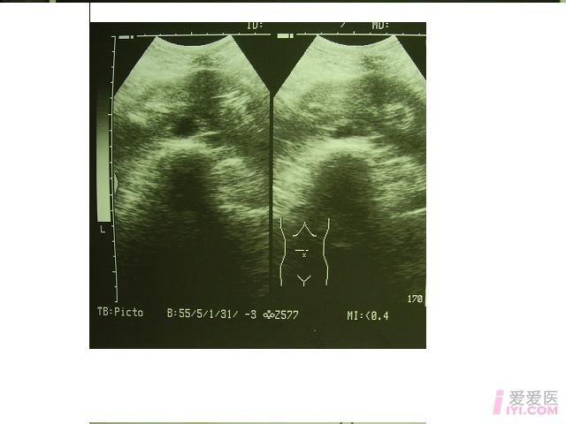 【分享】对侧融合肾 - 超声医学讨论版 - 爱爱医医学论坛