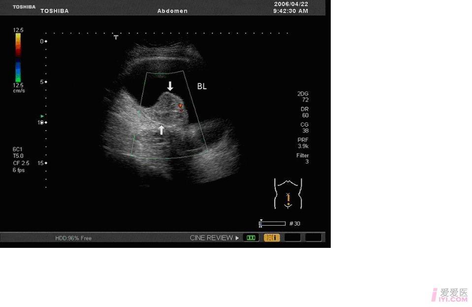 膀胱肿瘤彩超图片